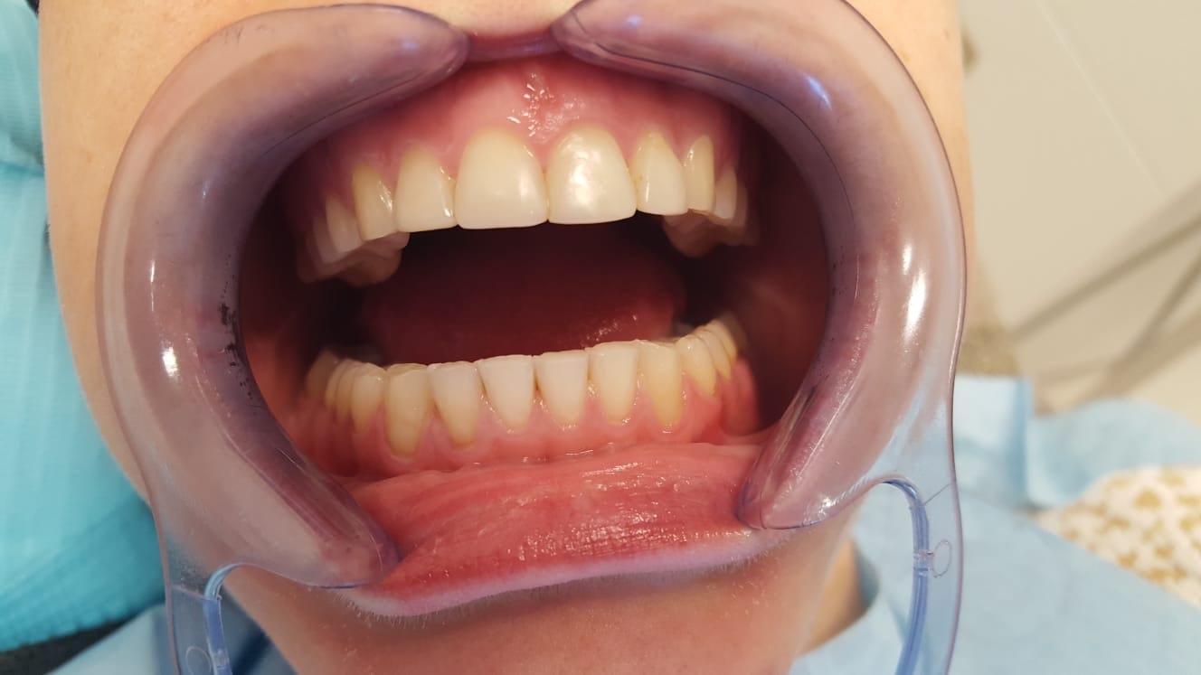 Wydłużanie zębów Smile Dentica PRZED